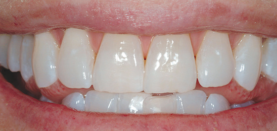 After Zoom whitening image