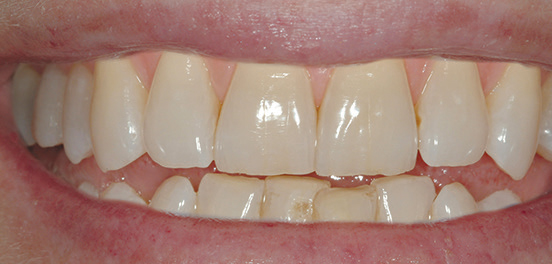 Before Zoom whitening image